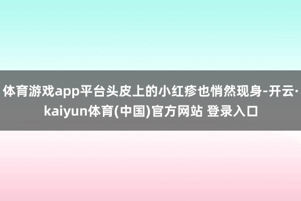 体育游戏app平台头皮上的小红疹也悄然现身-开云·kaiyun体育(中国)官方网站 登录入口